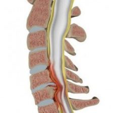 cervical-spinal-stenosis-1-224x300 cervical-spinal-stenosis-1-224x300