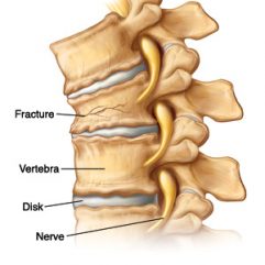 Side view of thoracic veretebrae showing a vertebral compression fracture  Pickup from 5B11843
Referenced from: KDAL #1B9131
12A11801
Also used as:
5a11362_Orphan1-Kdal0320