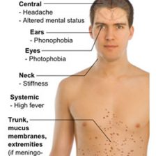 infections-of-the-spine-1 Spine surgeon in pune
