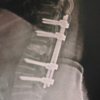 spinal-fracture-1-320x218