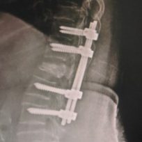 spinal-fracture-1-320x218 spinal-fracture-1-320x218