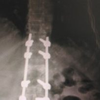 spinal-fracture-2-320x218