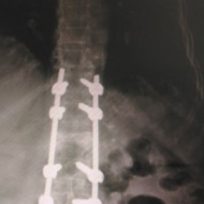 spinal-fracture-2-320x218 spinal-fracture-2-320x218
