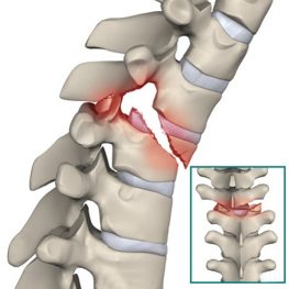 spinal-fracture Spine surgeon in pune