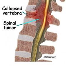 spinal_tumor spinal_tumor