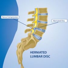 spine-disorder-herniated-lumbar-224x300