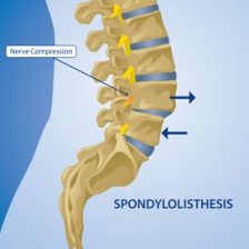 spondylolisthesis-224x300 spondylolisthesis-224x300