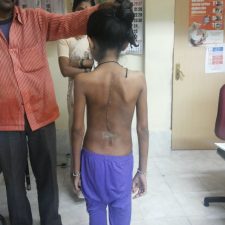 surgery_1 Spine surgeon in pune